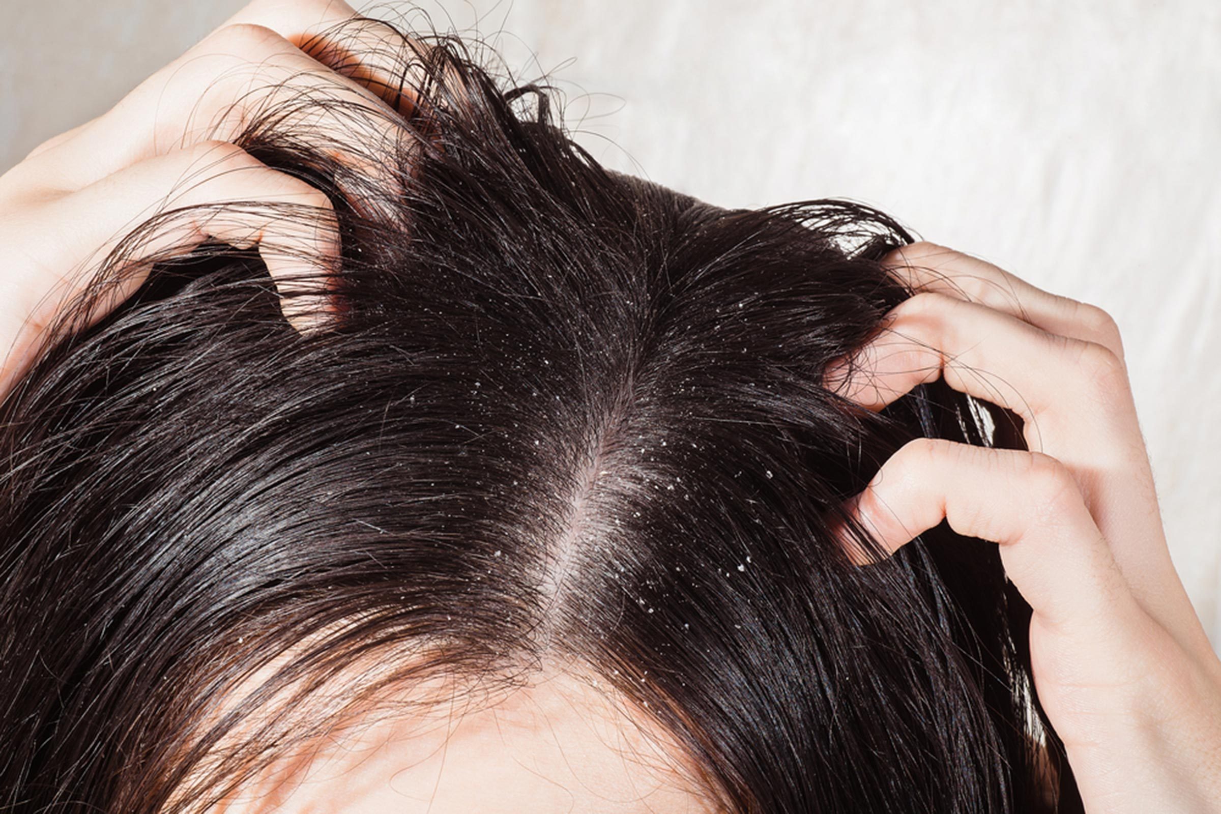 آیا چربی مو باعث ریزش میشود؟