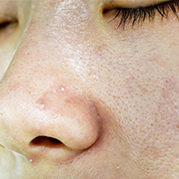 چرا پوست چرب میشود؟ روش های درمان و مراقبت از پوست صورت چرب