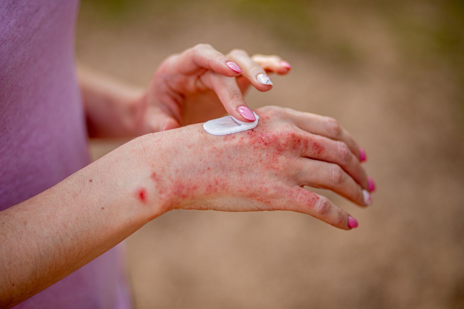درمان خانگی اگزمای دست و حساسیت پوستی