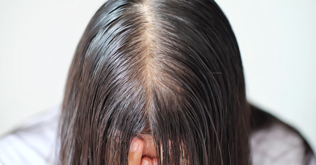 بهترین قرص ضد ریزش مو برای زنان و سایر روش های درمان